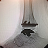 New Total Ankle Replacement System In Redding