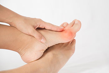 Photo of foot with a bunion. Bunion treatment is available at Shasta Orthopaedics.