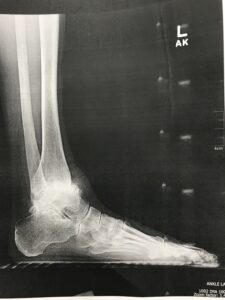 Total Ankle Replacement Arthroplasty x ray image a shasta orthopaedics 051721