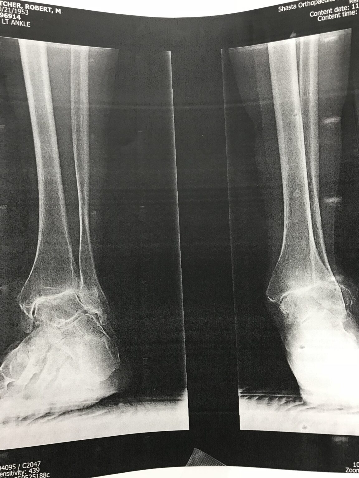 Total Ankle Replacement Arthroplasty X Ray Image B Shasta Orthopaedics