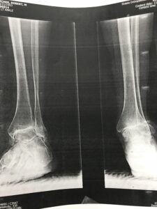 Total Ankle Replacement Arthroplasty x ray image b shasta orthopaedics 051721