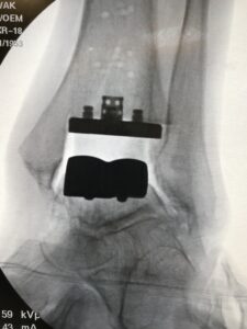 Total Ankle Replacement Arthroplasty x ray image c shasta orthopaedics 051721