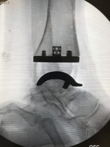 Total Ankle Replacement Arthroplasty x ray image d shasta orthopaedics 051721