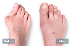 lapiplasty before and after 3d bunion correction a 051721