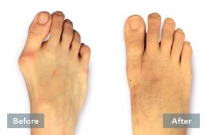lapiplasty before and after 3d bunion correction b 051721
