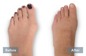 lapiplasty before and after 3d bunion correction c 051721