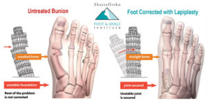 Lapiplasty illustration showing a foot with an untreated bunion on the left and a foot corrected with lapiplasty on the right.