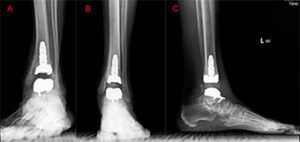 Revision total ankle replacement 