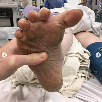 Reconstructive Surgery for Patient with Charcot Foot