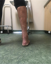 Shasta Ortho Foot Doctors Provide Total Ankle Replacement Revision