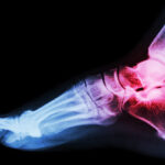 Ankle Revision Surgery: What It Is and When It Helps