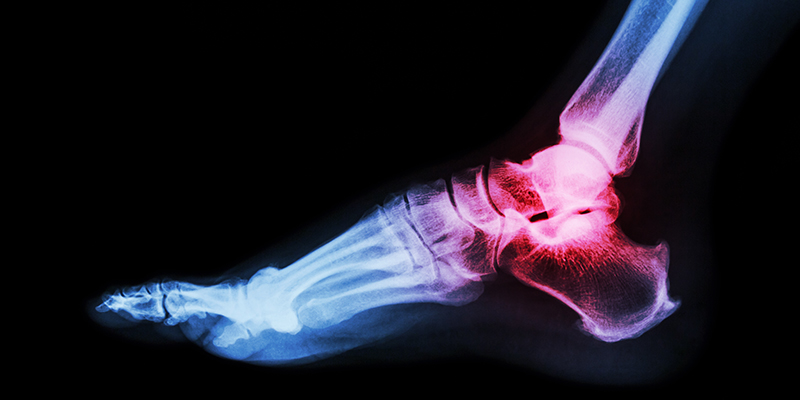Ankle Revision Surgery: What It Is and When It Helps