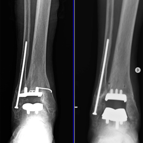 Ankle surgery x-ray
