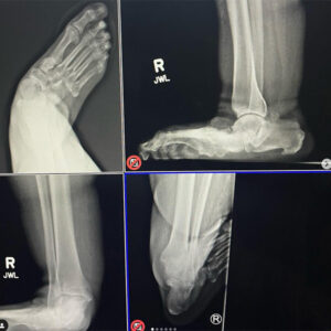 Ankle surgery x-ray